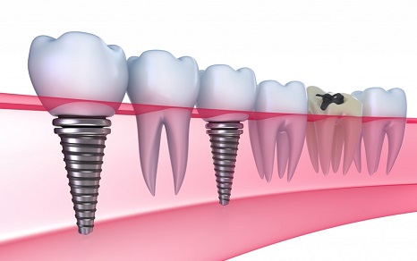 Diş İmplantı Nedir?