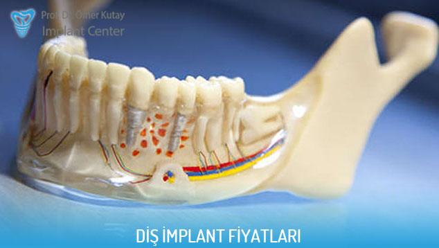 implant fiyatları 2019