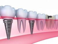 Diş İmplantı Nedir?